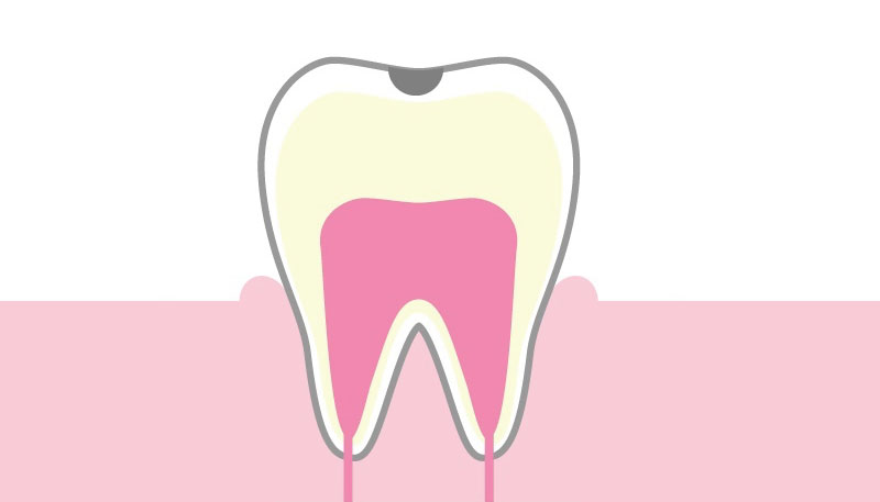 【C1】エナメル質内のう蝕