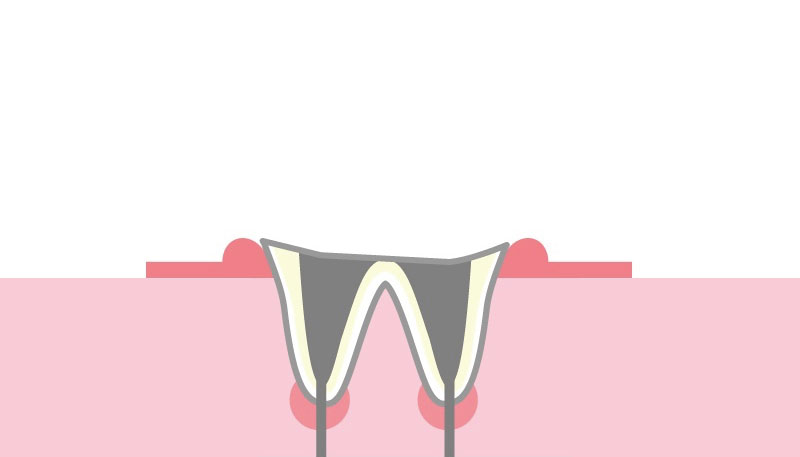 【C4】歯質が失われたう蝕
