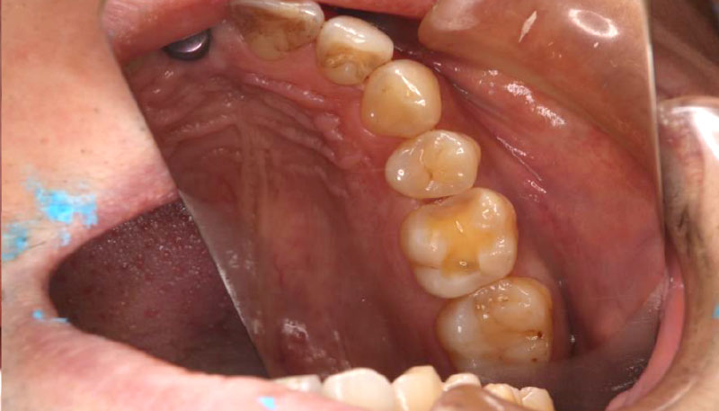 セラミック治療Case.02