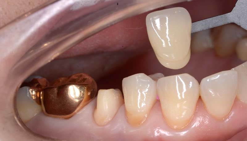 セラミック治療Case.03