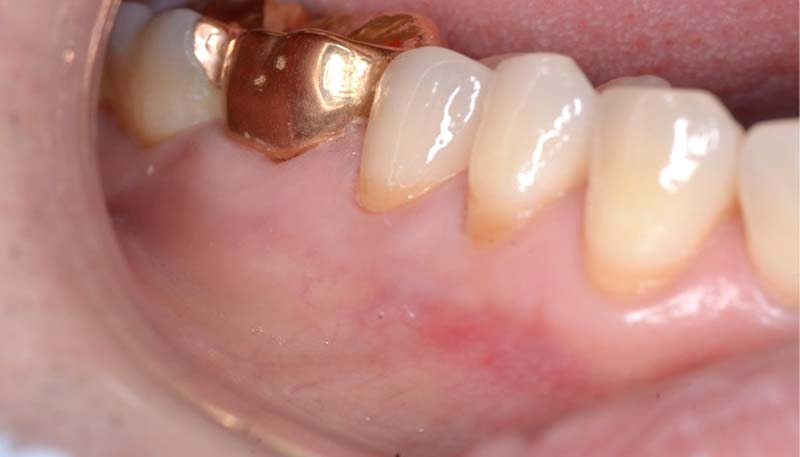 セラミック治療Case.03