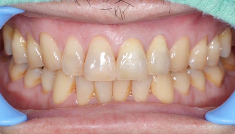 セラミック治療Case.04