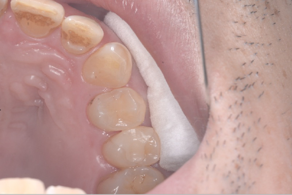 セラミック治療Case.04