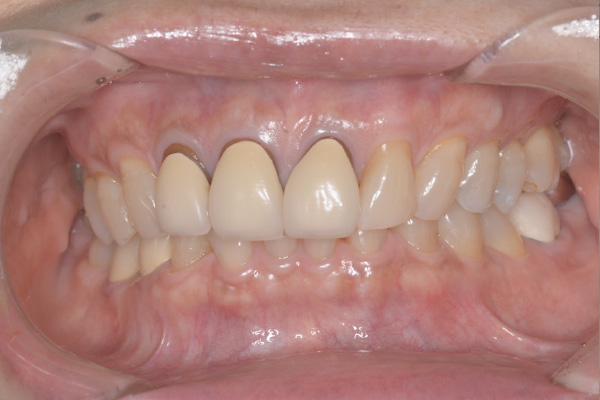 セラミック治療Case.06