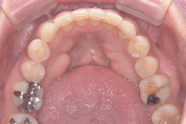 セラミック治療Case.05