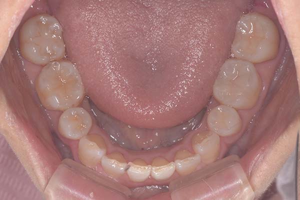 セラミック治療Case.08