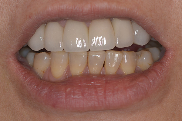 セラミック治療Case.10