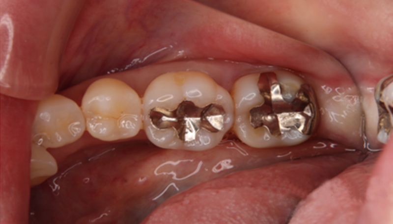 銀歯を白くする治療Case.01