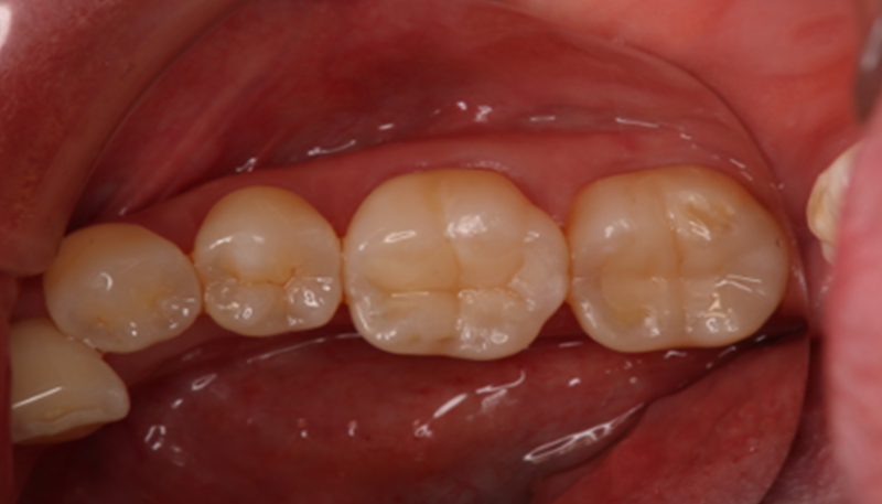 銀歯を白くする治療Case.01