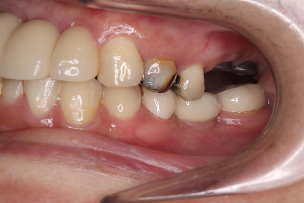 インプラントの症例