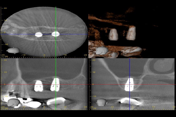 インプラントの症例