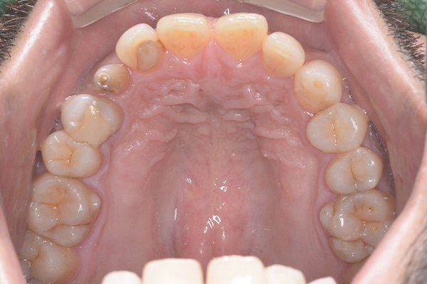 インプラントの症例