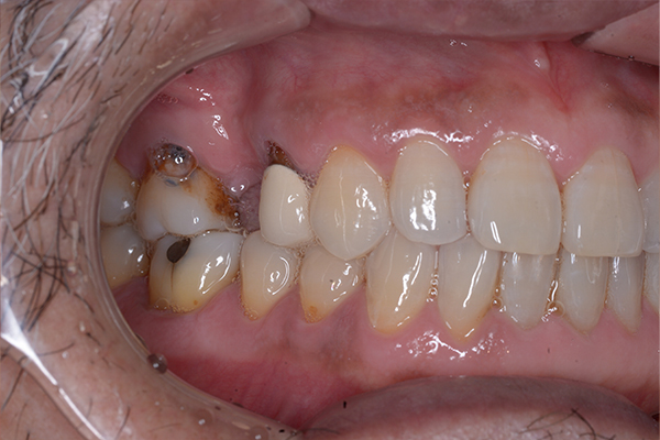 インプラントの症例