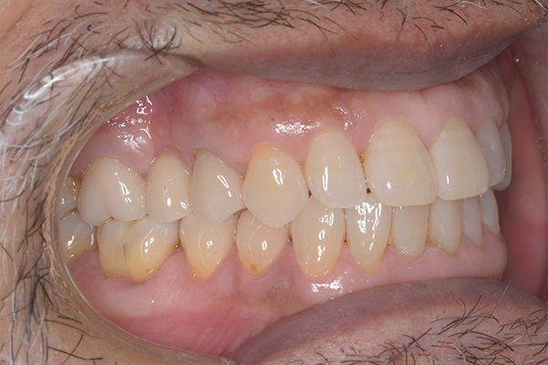 インプラントの症例