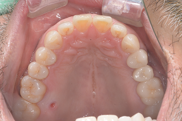 インプラントの症例