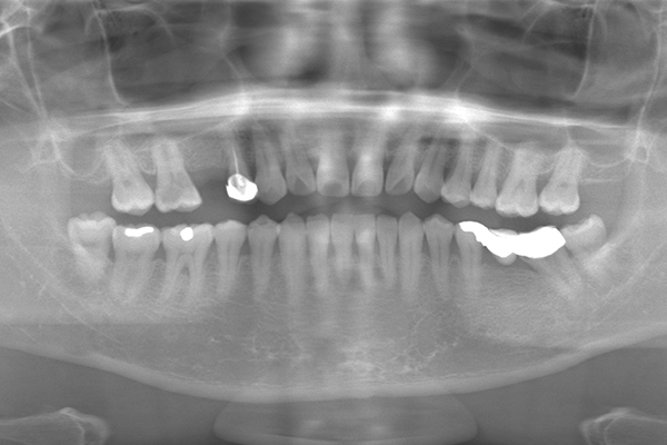 インプラントの症例