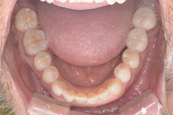 インプラントの症例