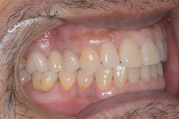 インプラントの症例