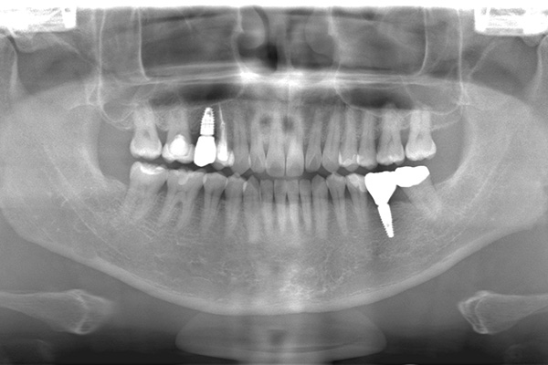 インプラントの症例