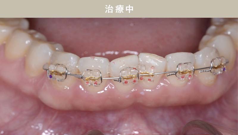 歯並び矯正Case.03