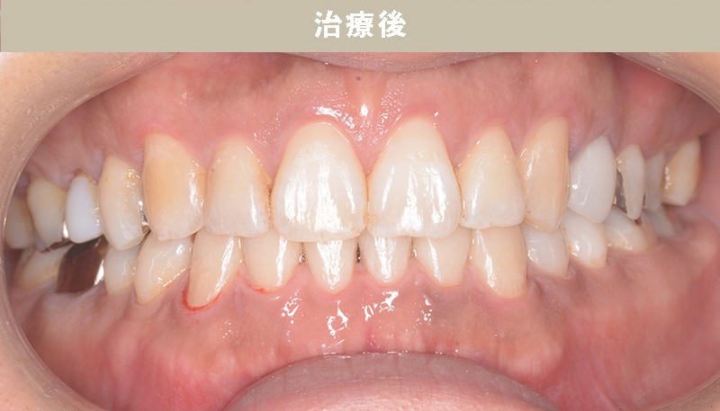 歯並び矯正Case.05