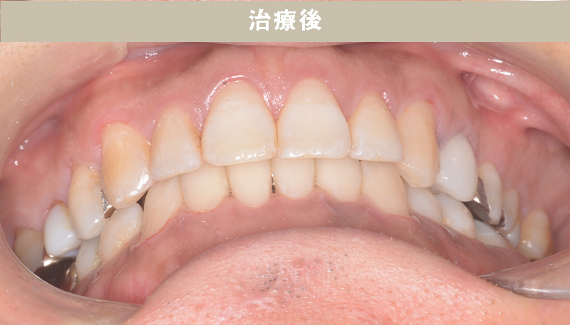 歯並び矯正Case.05