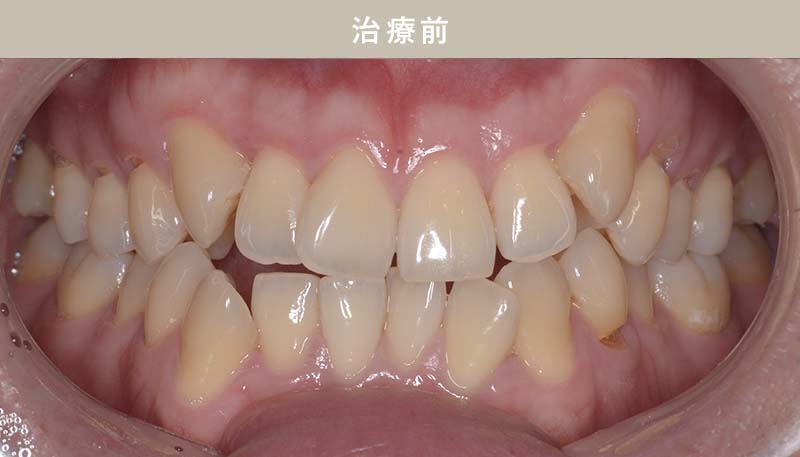 歯並び矯正Case.05