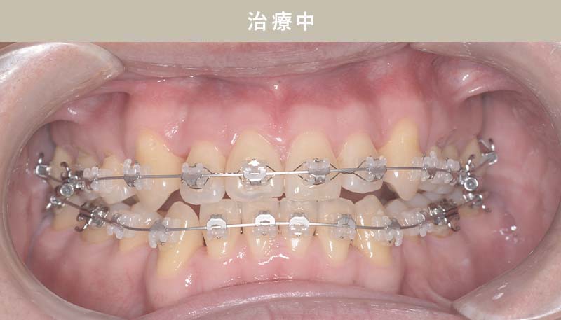歯並び矯正Case.05