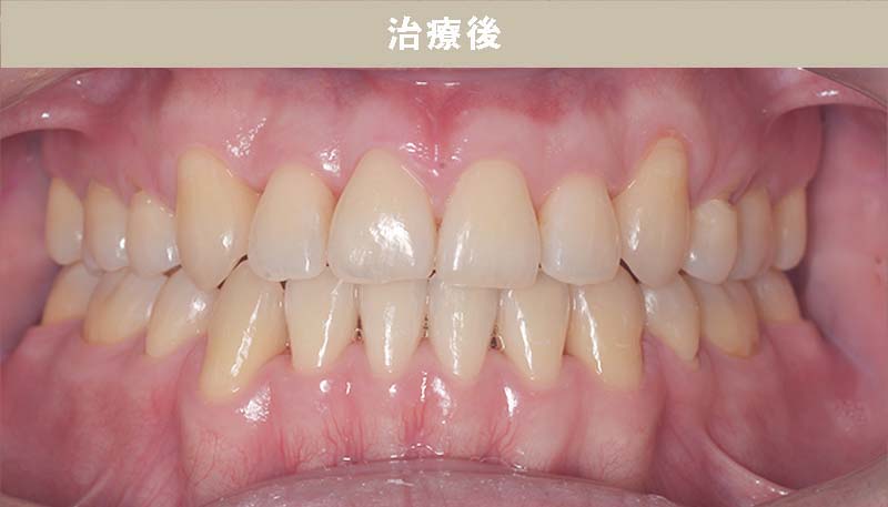 歯並び矯正Case.05