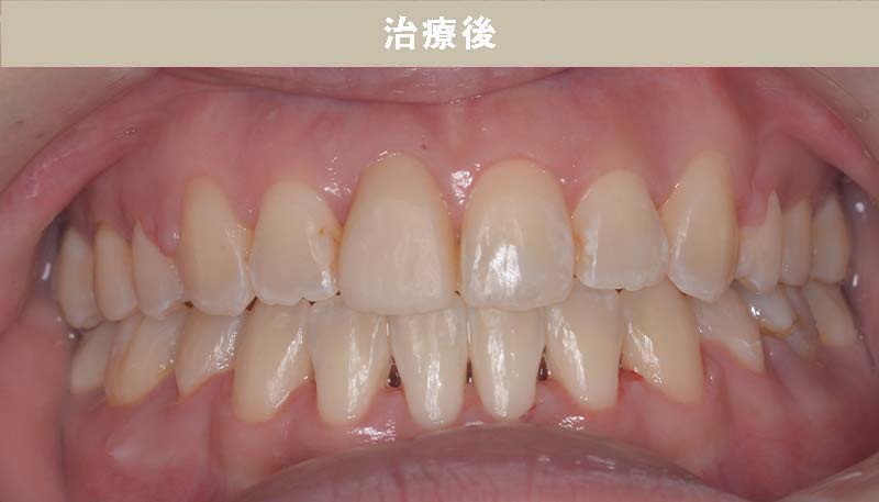 歯並び矯正Case.05