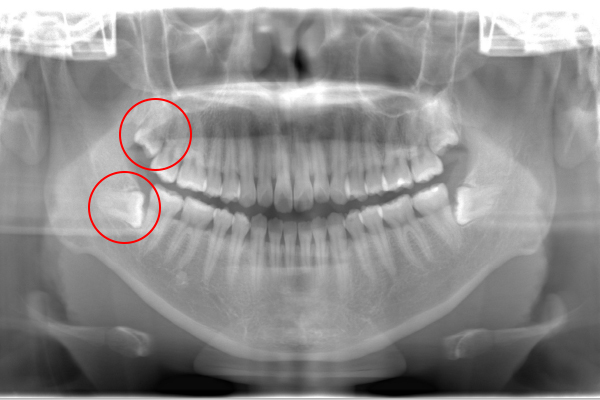 親知らず抜歯Case.01