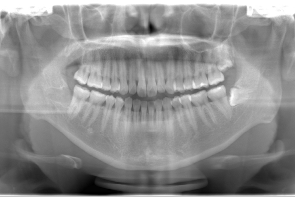 親知らず抜歯Case.01