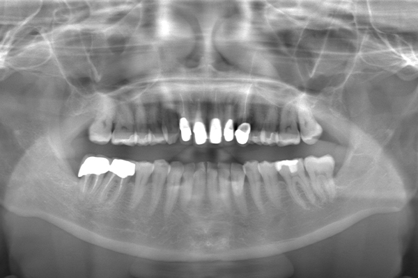 親知らず抜歯Case.01