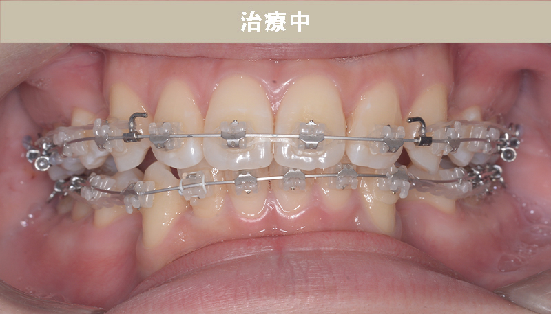 口ゴボの症例Case.04