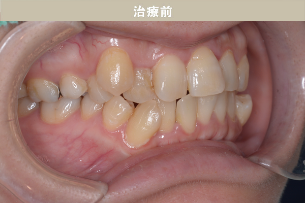 ワイヤー矯正・アンカスクリューの症例case.12