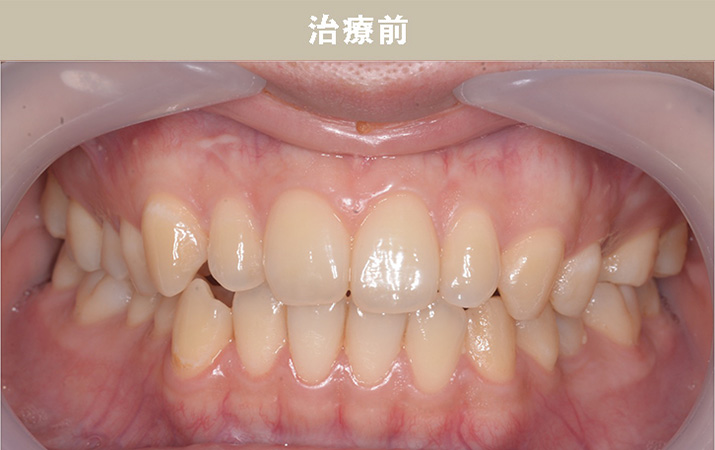 歯並び矯正Case.01