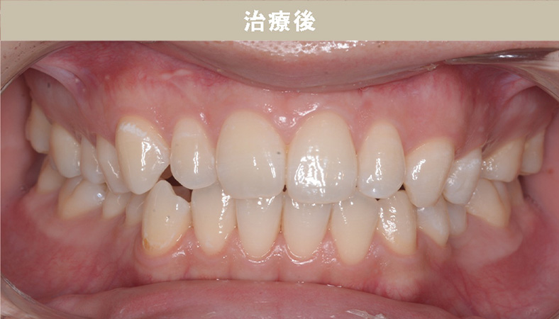 歯並び矯正Case.01