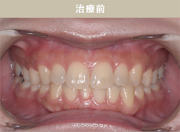 ホームホワイトニングCase.01