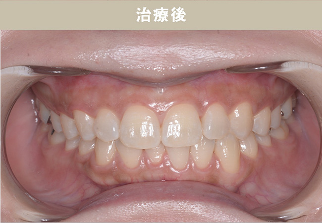 ホームホワイトニングCase.02