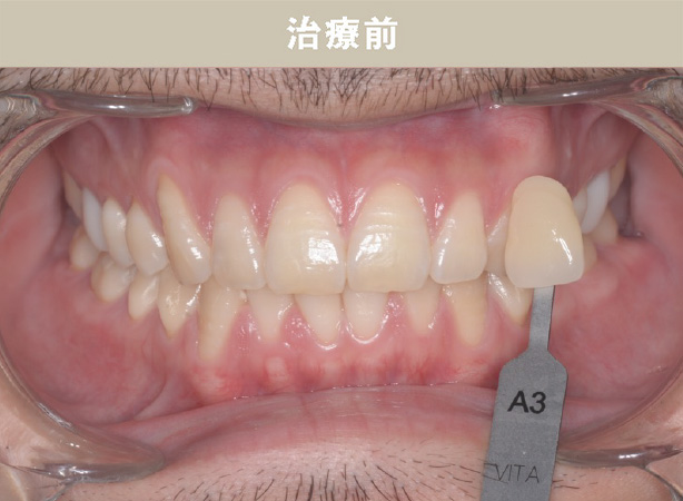 ホームホワイトニングCase.01