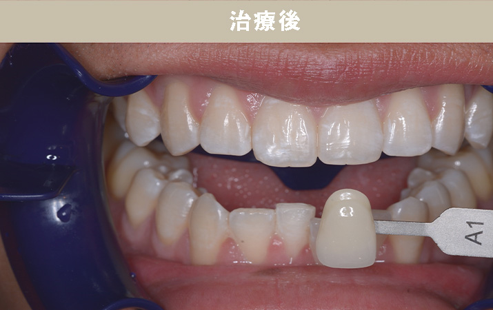 歯並び矯正Case.01